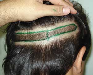 Máscara de crescimento e fortificação de remédios de gente de cabelo